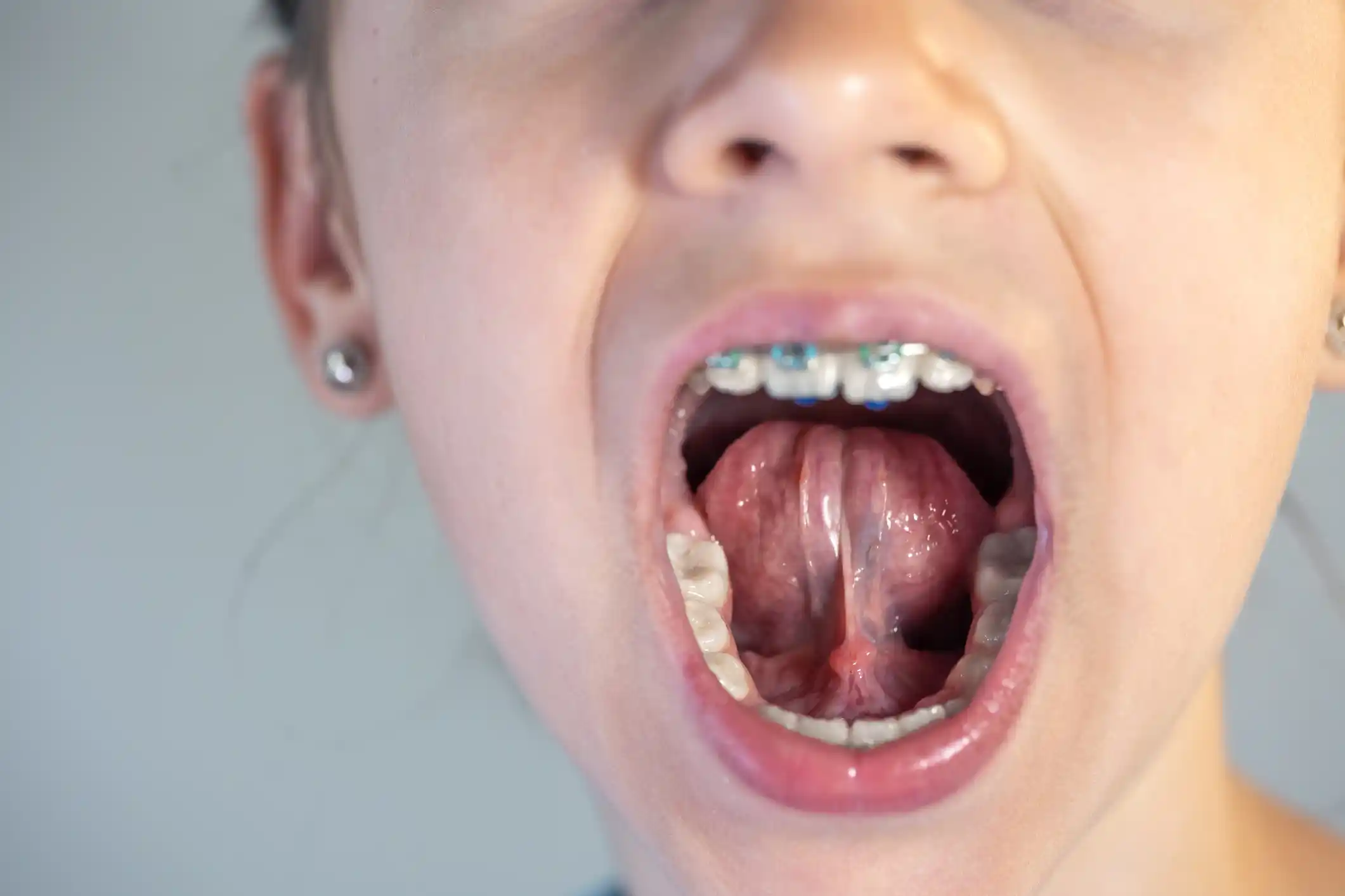 Tongue tied girl needing a Frenectomy.
