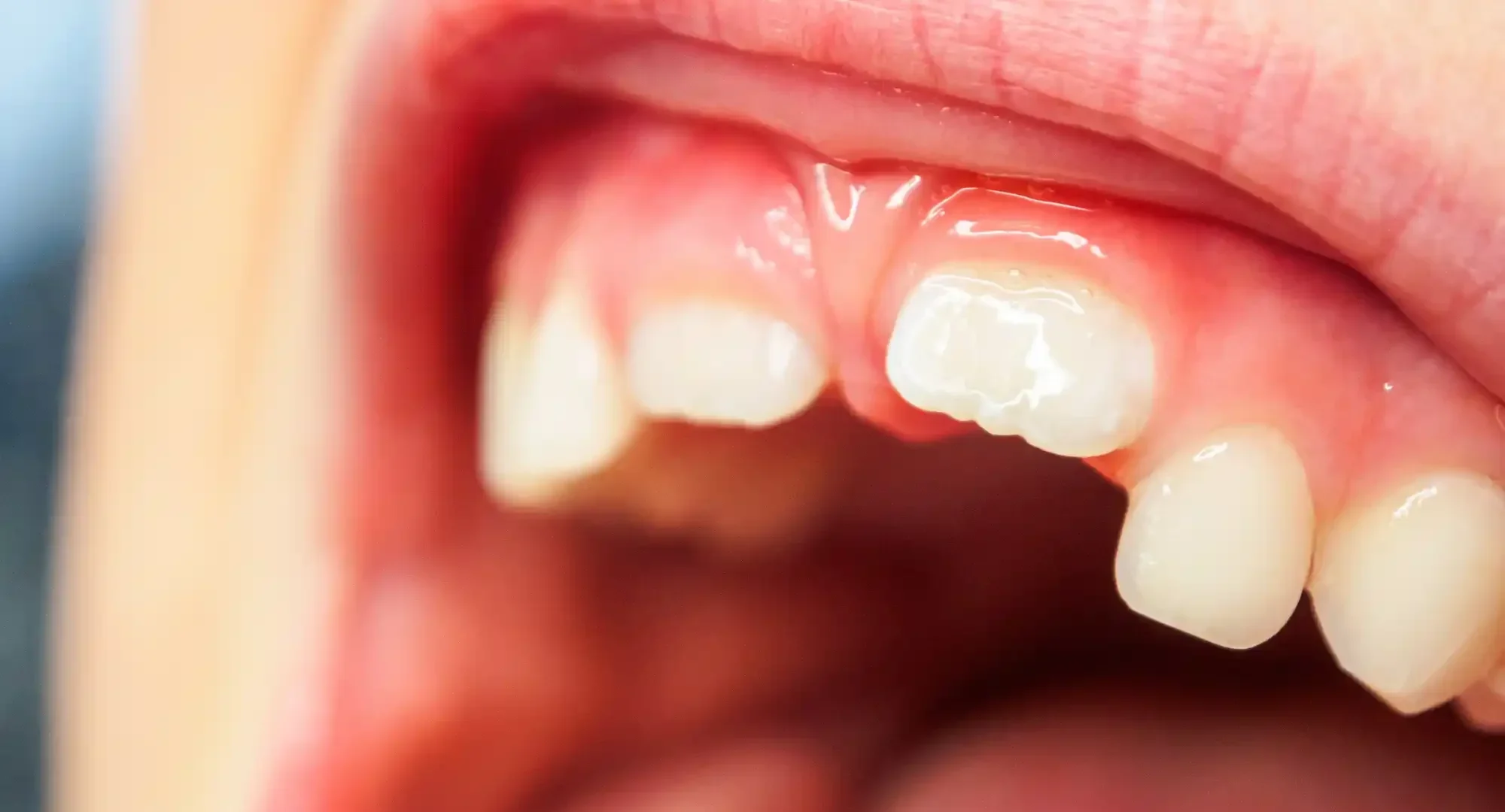 young lip tied kid before a labial frenectomy